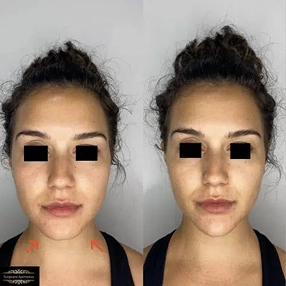 Chin & Jawline Filler before and after 8