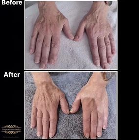 Hand Filler Before and after 1