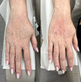 Hand Filler Before and after 2