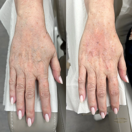Hand Filler Real Transformations