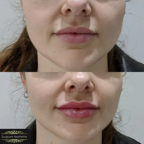 Lip-Filler-Treatment_5.jpg