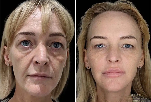 Nasolabial & Marionette Line Filler Real Transformations