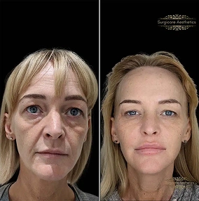 Nasolabial & Marionette Line before and after 2