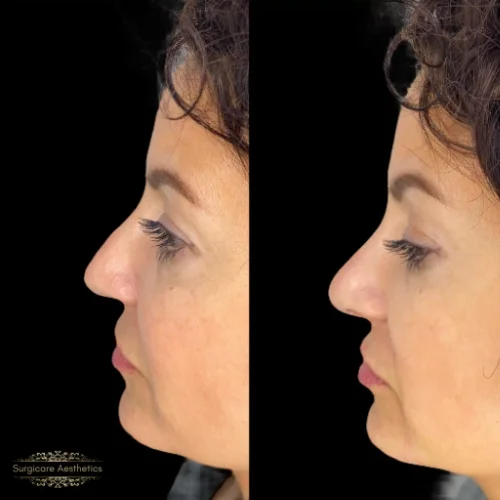 Non-Surgical Rhinoplasty