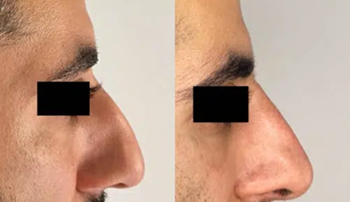 Nose Filler real transformations 2