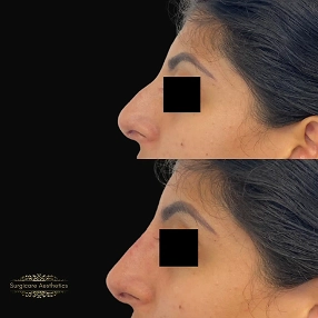 Nose filler before and after 1