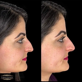 Nose filler before and after 3