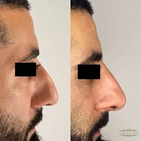 Nose filler before and after 6