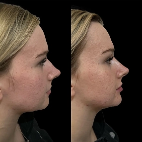 Nose filler before and after 8