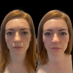 Nose filler before and after 9