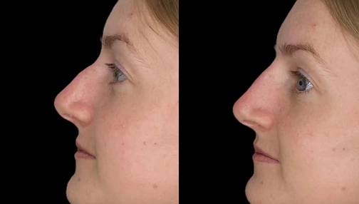 Nose filler real transformations
