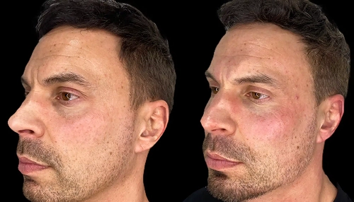 Tear Trough Filler Real Transformations 2