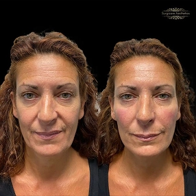 Tear Trough Filler before and after 1