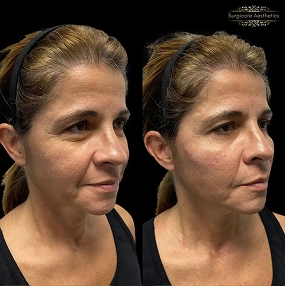 Tear Trough Filler before and after 3