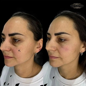 Tear Trough Filler before and after 4