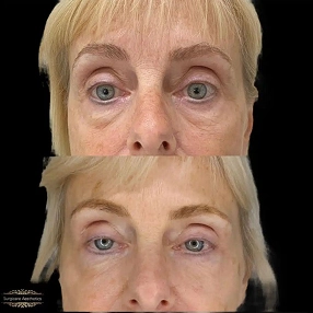 Tear Trough Filler before and after 5