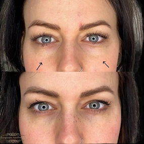 Tear Trough Filler before and after 7