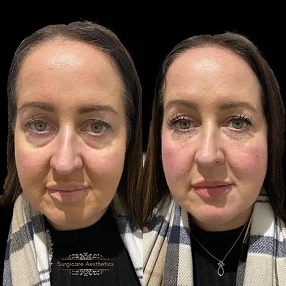 Tear Trough Filler before and after 9